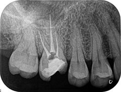 右上第一大臼歯の再根管治療　2015.01.10