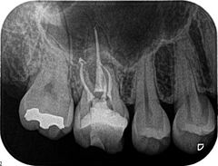 右上第一大臼歯の再根管治療　2015.01.13