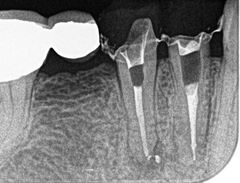 右下小臼歯2本の再根管治療 2015.02.14