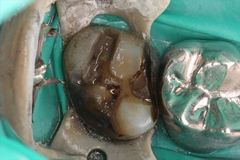 虫歯になって金属でカバーした内部が黒くなっている右上奥歯 2015.03.27