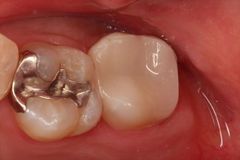 レジン充填の周囲からむし歯になっていた大臼歯のセラミック1日治療2015.04.14