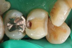 金属との接触面からむし歯が発生しているケース 隣接面カリエス2015.04.18
