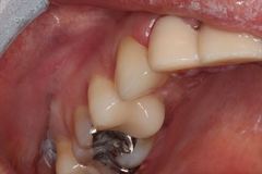 酸蝕歯の知覚過敏が改善しました。セラミック治療 2015.04.07