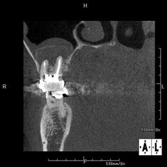 大きな根尖病変・上顎洞炎の根管治療後の治癒のCT画像　2015.04.17 右上大臼歯