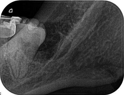 下顎水平智歯抜歯レントゲン2012.6.14_R.jpg