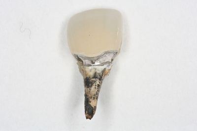 歯科用金属の腐食　IMG_4659_R.jpg