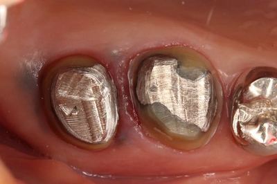 メタルタトゥーが歯の周囲に存在している大臼歯の写真