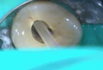 グライド注入2014.07.05.gif
