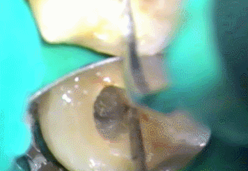 超音波スケーラー2014.07.05.gif