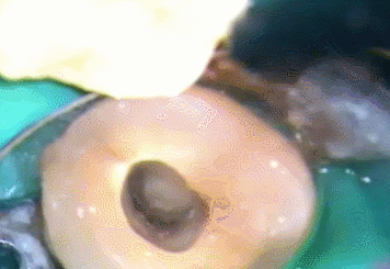 髄腔拡大2014.07.05.gif