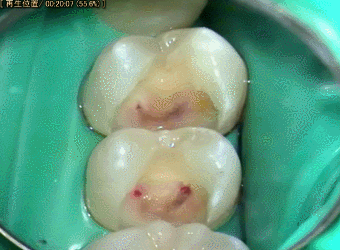 露髄部分の確認2014.08.06.gif