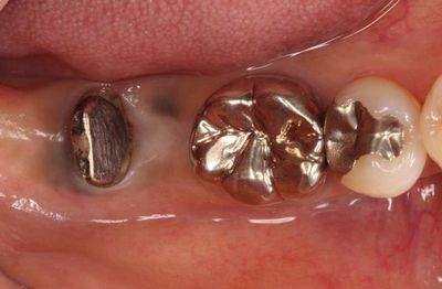 IMG_1815R80.jpg金属の粒子が歯ぐきに入り込んだメタルタトゥーの写真