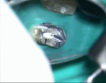 コア除去開始2015.01.17.gif