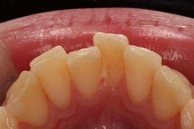 下顎前歯舌側の歯石IMG_9602R82.jpg