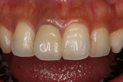 治療開始時：右上前歯メタルボンドIMG_1636R8.jpg