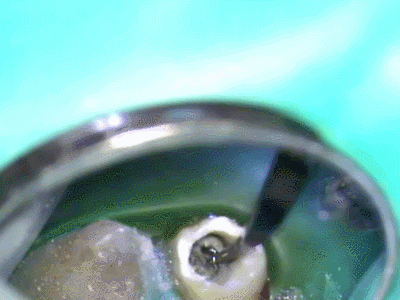 超音波スケーラーで振動を加える2015.03.17.gif