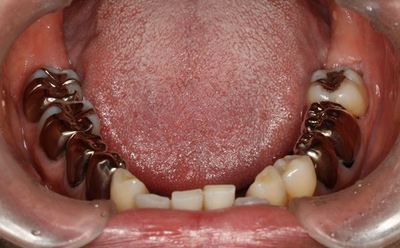金属のある口腔の舌の状態IMG_0030R84.jpg