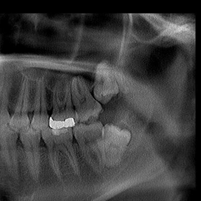 左上埋伏智歯パノラマ画像CT_20150415.jpg