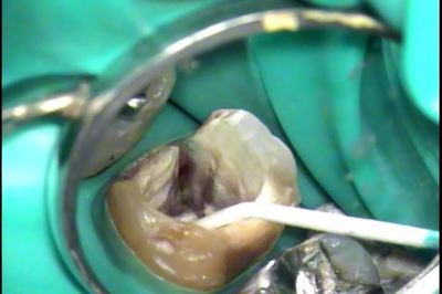 歯根のヒビ割れ2015.06.04.jpg