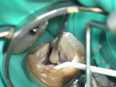 歯根のヒビ割れをレジンで修復2015.06.04.gif