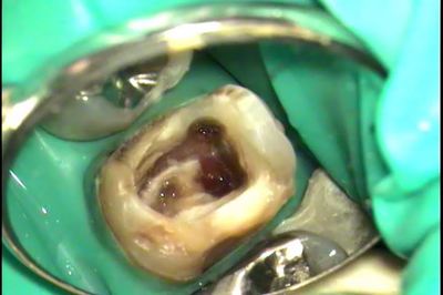 歯根のヒビ割れをレジンで修復後2015.06.04.jpg