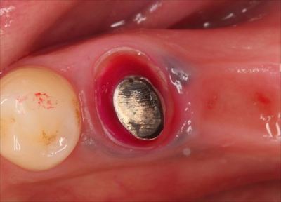 右下第二小臼歯の周囲に金属粒子が歯ぐきに入り込んだメタルタトゥーが存在している写真IMG_6461_R88.JPG