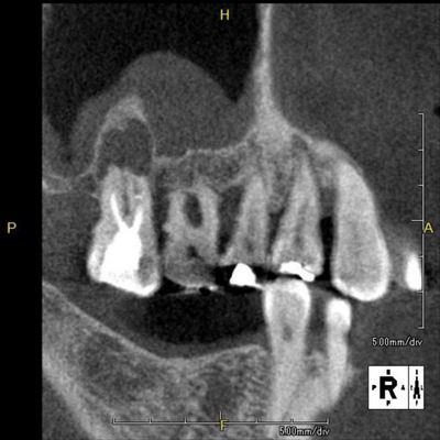 歯性上顎洞炎断面CT2015.09.05.jpg