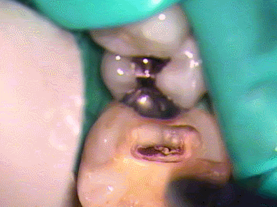 石灰化した歯髄2015.10.07.gif