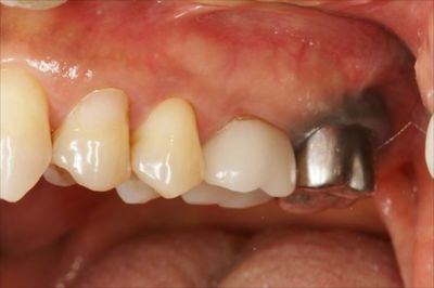 左上第二大臼歯のメタルタトゥー金属粒子が歯ぐきに入り込んだ状態の写真IMG_1044_R89.JPG