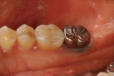 右下第二大臼歯のメタルタトゥー金属粒子が歯ぐきに入り込んだ状態の写真IMG_1052_R89.JPG