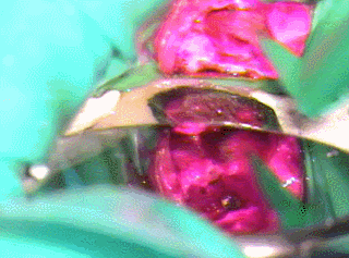 う蝕検知液を塗布する2016.01.30.gif