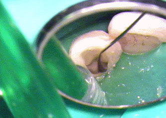 薬液洗浄2013.01.13.gif