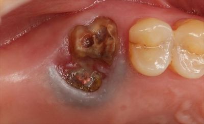 左上第一大臼歯のメタルタトゥー金属粒子が歯ぐきに入り込んだ状態の写真IMG_3655_R22.JPG
