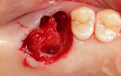 左上第一大臼歯の抜歯とメタルタトゥー金属粒子が入り込んだ歯ぐきを切除した状態の写真IMG_3676_R22.JPG