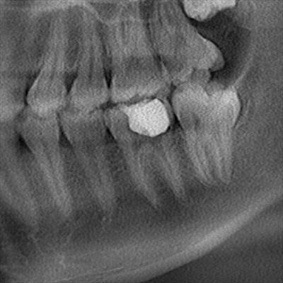 CT_20170127235753_R23.jpg