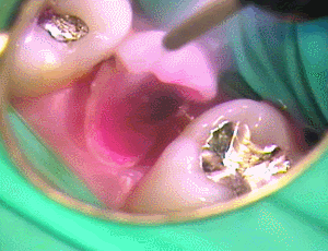 検知液を水洗2017.03.09.gif