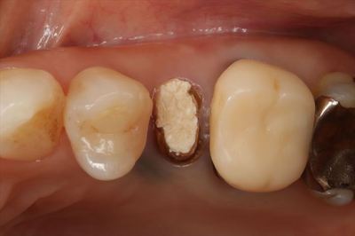 ボロボロになった左上第二小臼歯の周囲にメタルタトゥー金属粒子が歯ぐきに入り込んだ状態の写真IMG_3760_R23.JPG