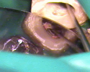 ガッタパーチャをさわると膿が出てくる2017.06.29.gif