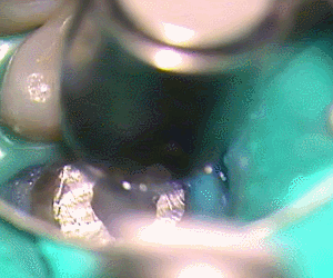 チタンのメタルコア除去1.gif
