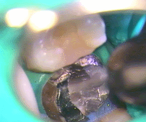 チタンのメタルコア除去2.gif