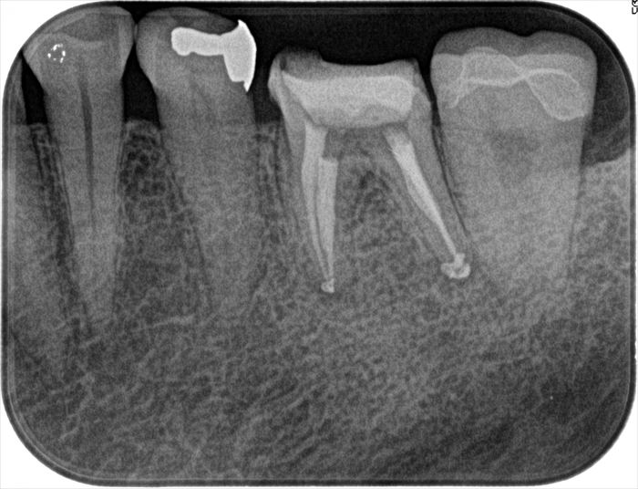 左下第一大臼歯の再根管治療を終えました。2022.05.12