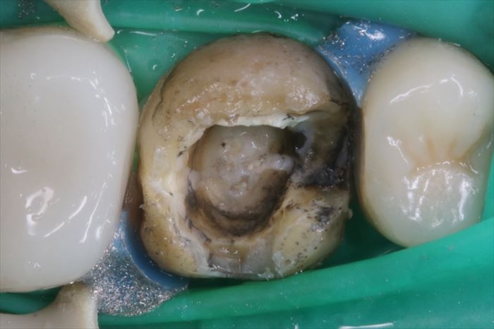 右上第一大臼歯のメタルクラウンとメタルコアを除去した内部です。2022.05.17