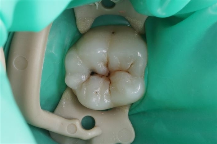 左下第一大臼歯の裂溝のコンポジットレジン修復しました。2022.05.27
