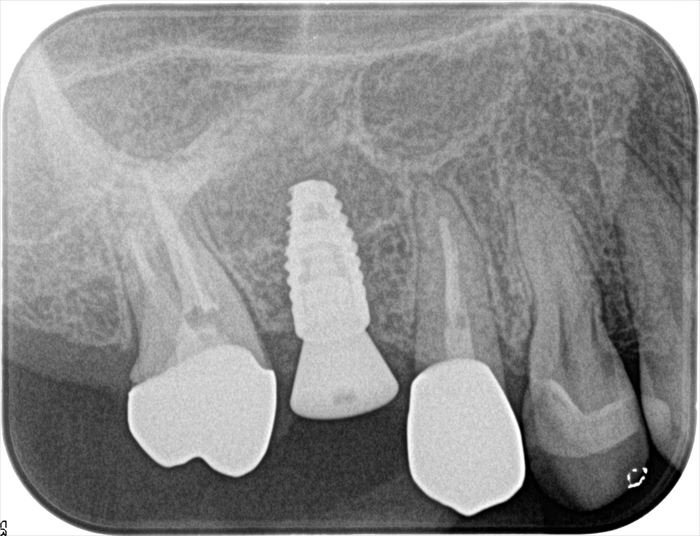 右上第一大臼歯部分にインプラントを埋入しました。2022.07.14