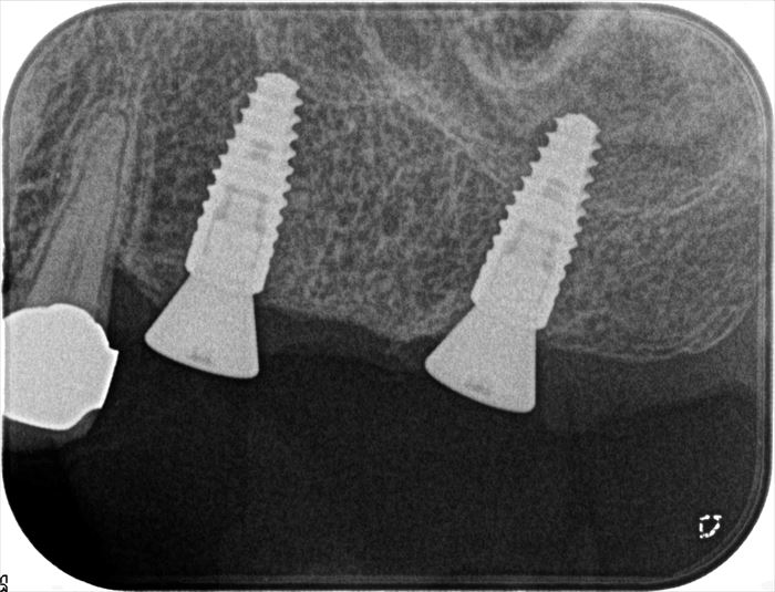 左上第二小臼歯・第二大臼歯部分にインプラントを埋入しました。2022.07.21