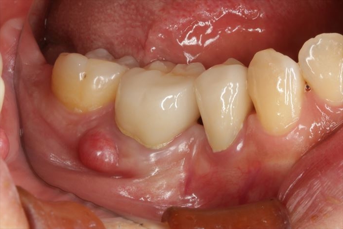 膿瘍を形成している右下第一大臼歯を抜歯しました。2022.07.07 スポンゼル いつまで