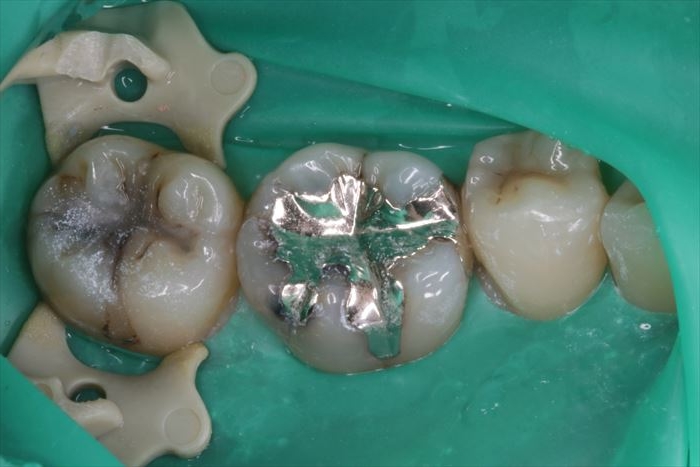 金属のつめもの内部のむし歯と、接していた部分のむし歯 2022.08.19