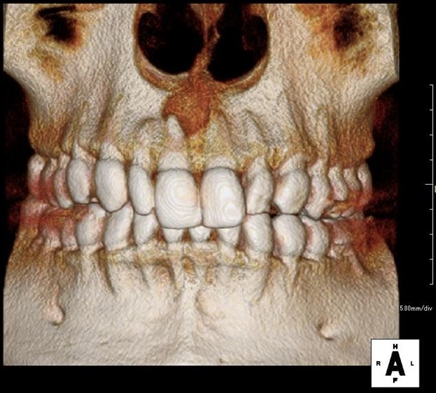 右上中切歯右上前歯の根の先端に膿が溜まっている状態の歯科用CT立体画像