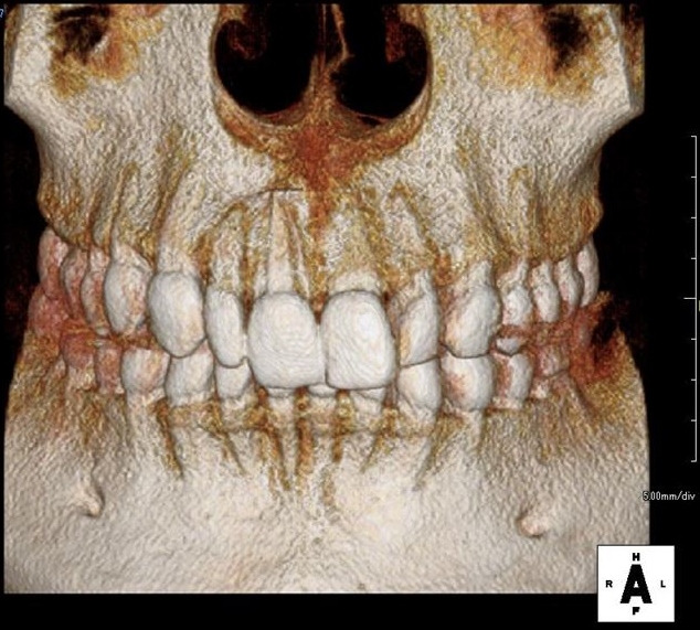 右上中切歯右上前歯の根の先端に膿が溜まっていた歯が治癒した状態の歯科用CT立体画像