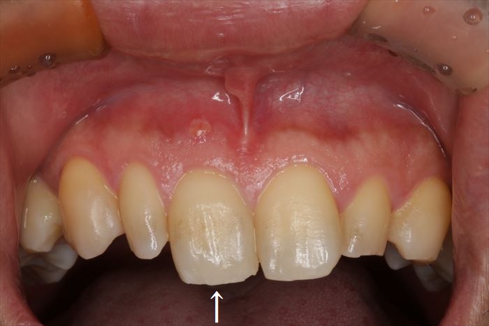 右上中切歯右上前歯の根の先端に膿が溜まっていてフィステル瘻孔が形成されている状態の写真
